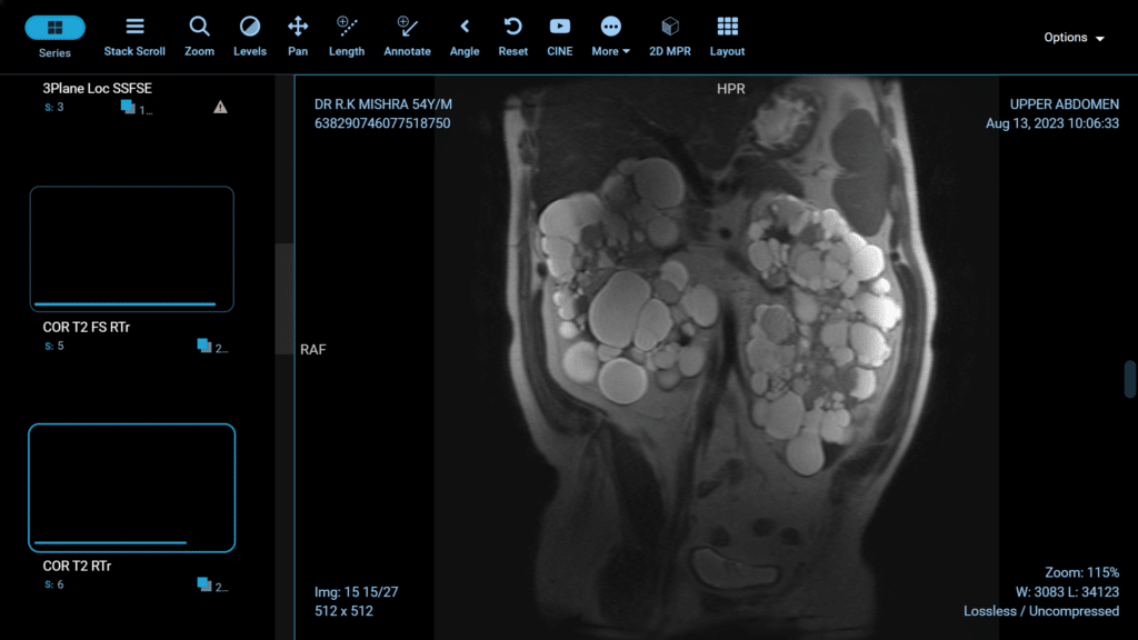 laparoscopic blog 5